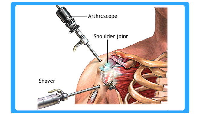 arthroscopy-surgery-in-bhiwandi-thane