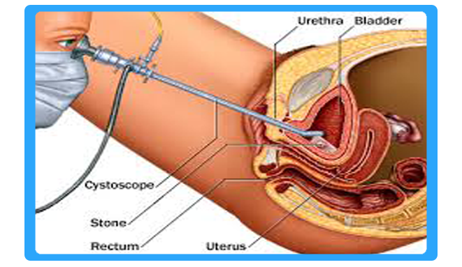 cystoscopy-surgery-in-bhiwandi-thane