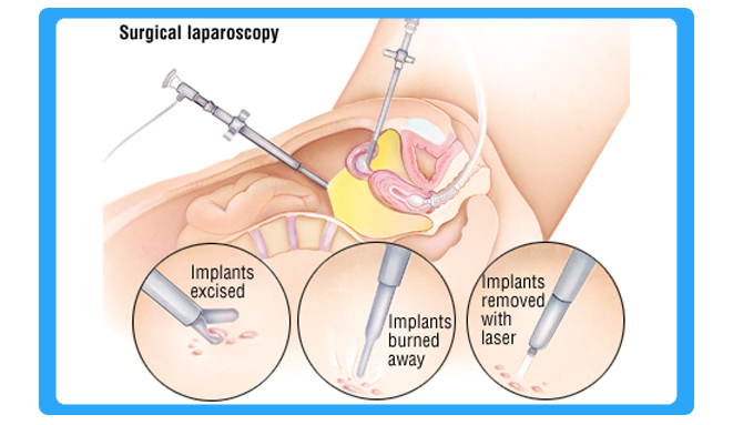 diagnostic-laparoscopy-in-bhiwandi-thane