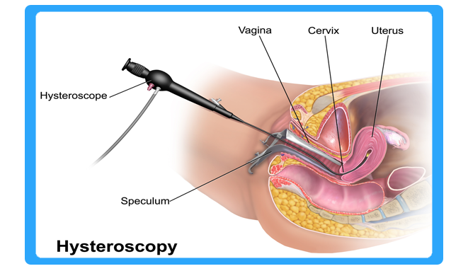 Hysteroscopy Surgery in bhiwandi thane
