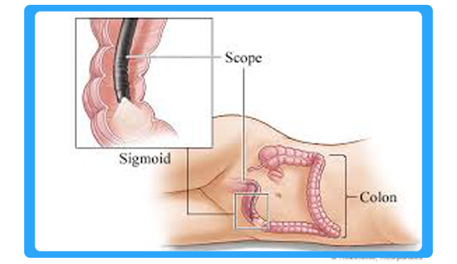 sigmoidoscopy-surgery-in-bhiwandi-thane